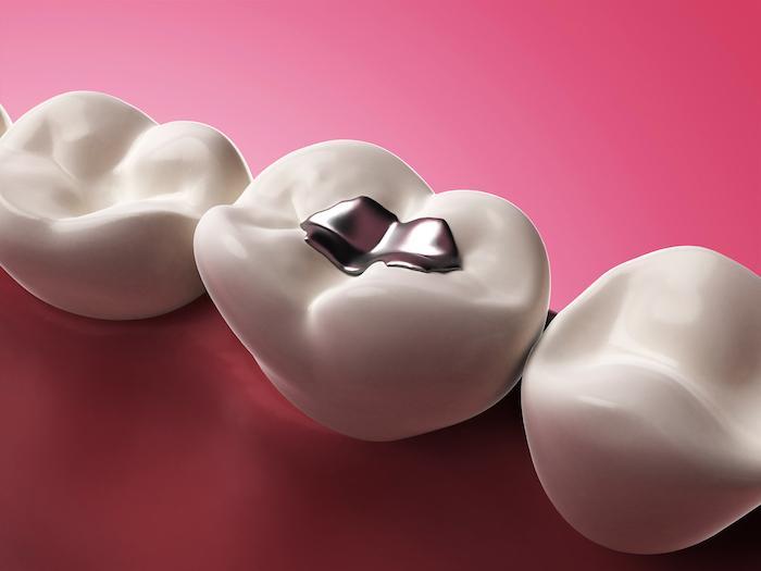 Consider These Benefits of Dental Implants