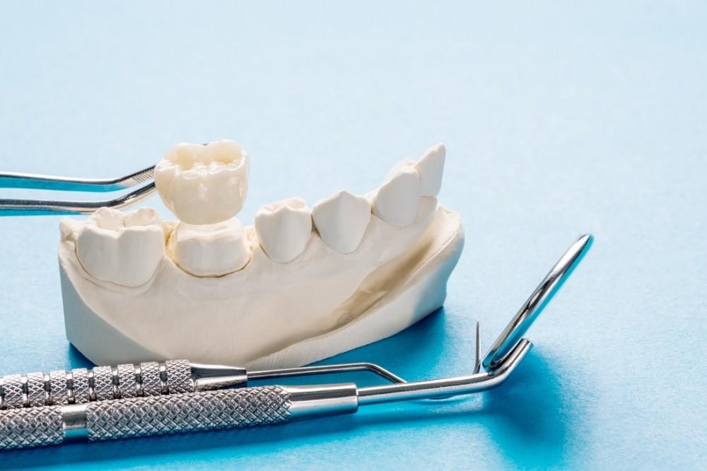 Understanding the Materials That Are Used to Make Crowns and Bridges