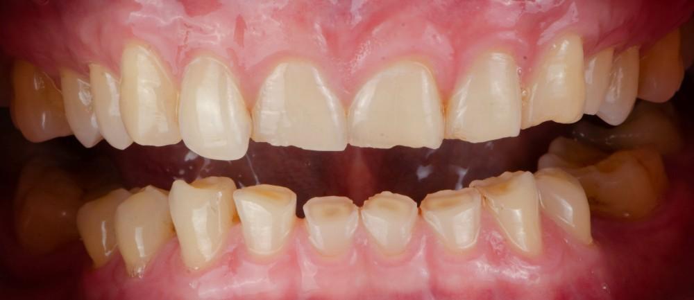 Why Grinding Your Teeth While Sleeping Does More Damage Than You Think